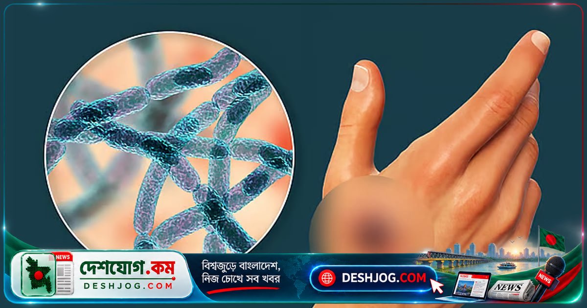 অ্যানথ্রাক্সে আক্রান্ত শতাধিক মানুষ: পাঁচ জেলায় ছড়িয়ে পড়েছে জুনোটিক রোগ