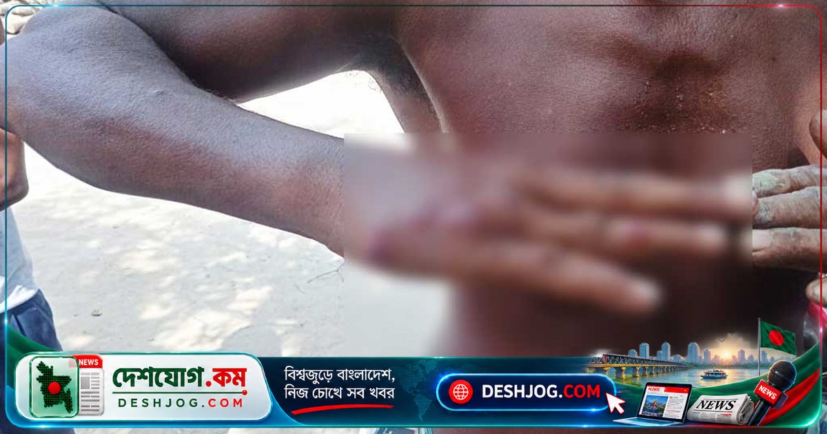 সুন্দরগঞ্জে অ্যানথ্রাক্সে আক্রান্ত পাঁচজন, সরকারি ব্যবস্থা নেই প্রতিরোধে