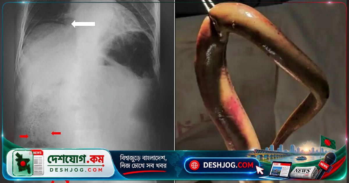 বাংলাদেশে মাছের কাঁটায় আক্রান্ত রোগীর অন্ত্রে প্রবেশ করে জীবন্ত বাইম মাছ: চিকিৎসা বিজ্ঞানের বিরল ঘটনা