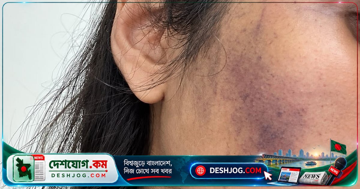বনশ্রীতে কুকুর খাওয়ানোর নামে মারধর: তরুণী সুমাইয়া রহমানের শরীরে আঘাতের চিহ্ন