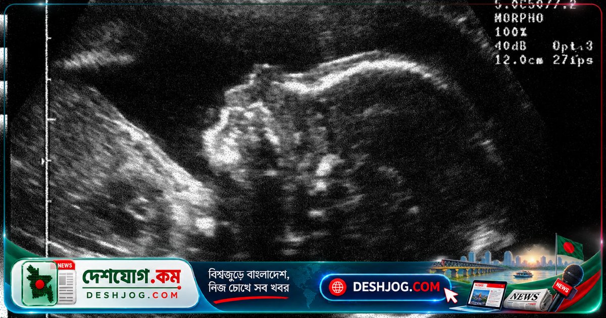গর্ভস্থ শিশুর ফুসফুসে বড় টিউমার: চীনা চিকিৎসকদের মাইক্রোওয়েভ পদ্ধতিতে সফল অস্ত্রোপচার ছাড়াই ছোট করা