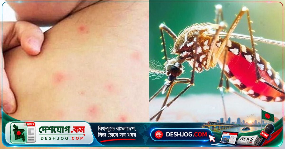 হাম ও ডেঙ্গুতে দেশে দিনে দিনে বাড়ছে মৃত্যু: হাসপাতালে চিকিৎসা ব্যবস্থা চাপে