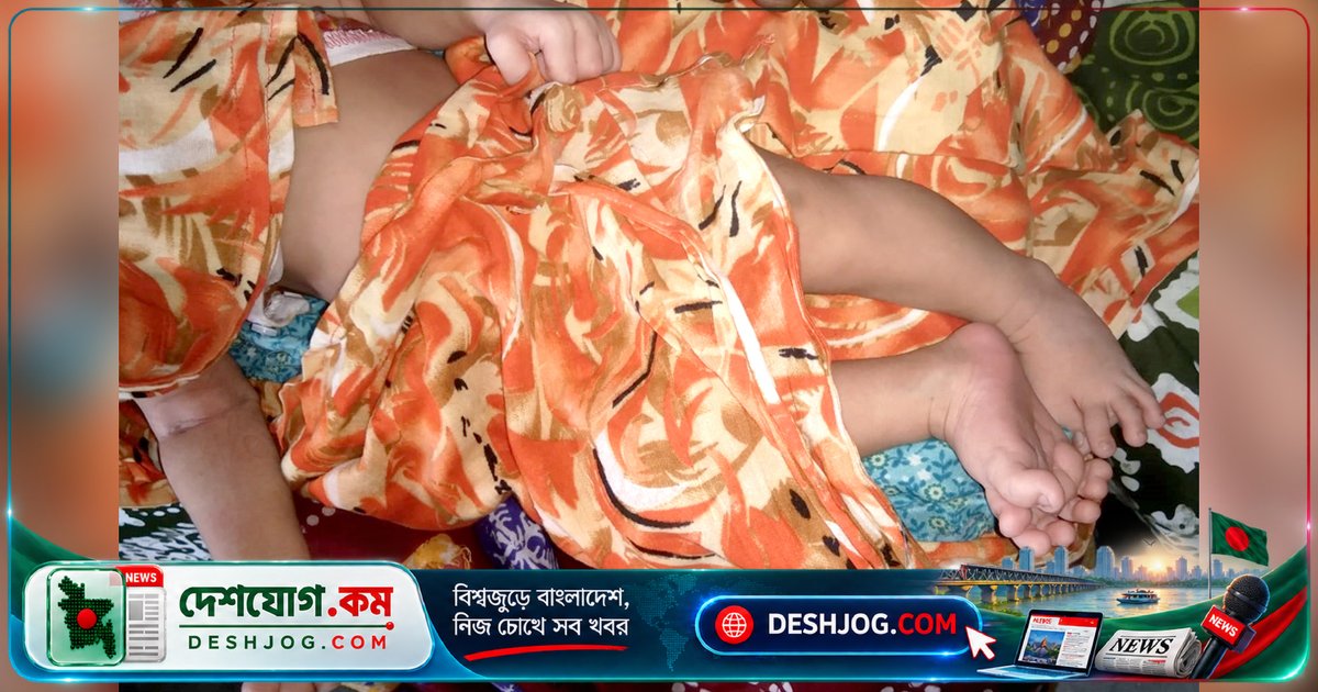 দিনাজপুরে ২৮টি আঙুল নিয়ে জন্মগ্রহণকারী নবজাতক: বিশেষজ্ঞের সতর্কবার্তা