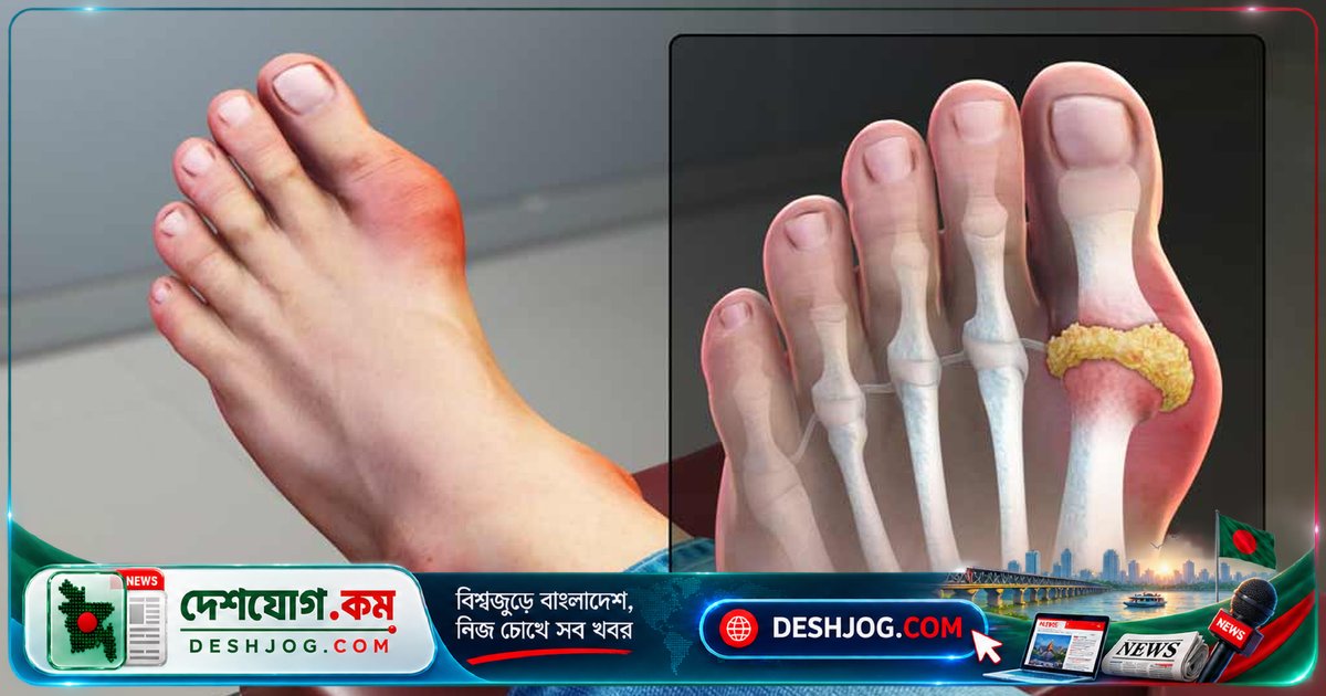 গেঁটেবাতের সঙ্গে জড়িত যৌন অক্ষমতা: তরুণদের মধ্যে বেড়ে চলেছে এই দুটি রোগের সংযোগ
