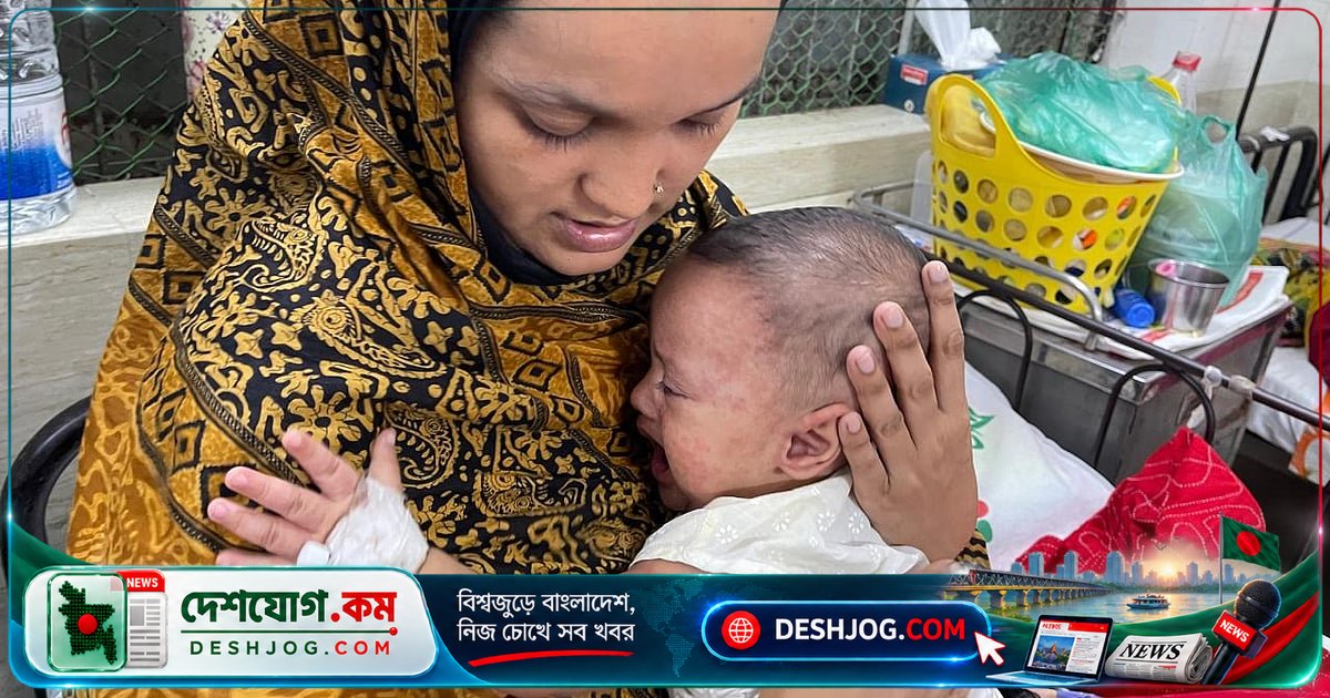 হাম-নিউমোনিয়া জটিলতা: প্রত্যন্ত অঞ্চল থেকে ঢাকায় আসা শিশুদের জীবন সংকটে
