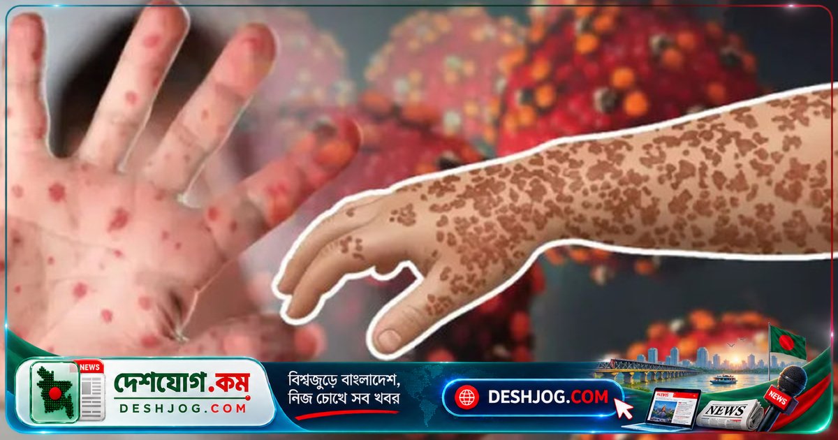 ২৪ ঘণ্টায় হামের কারণে ৬ জনের মৃত্যু, ১৪৬৬ জন আক্রান্ত: স্বাস্থ্য অধিদপ্তর