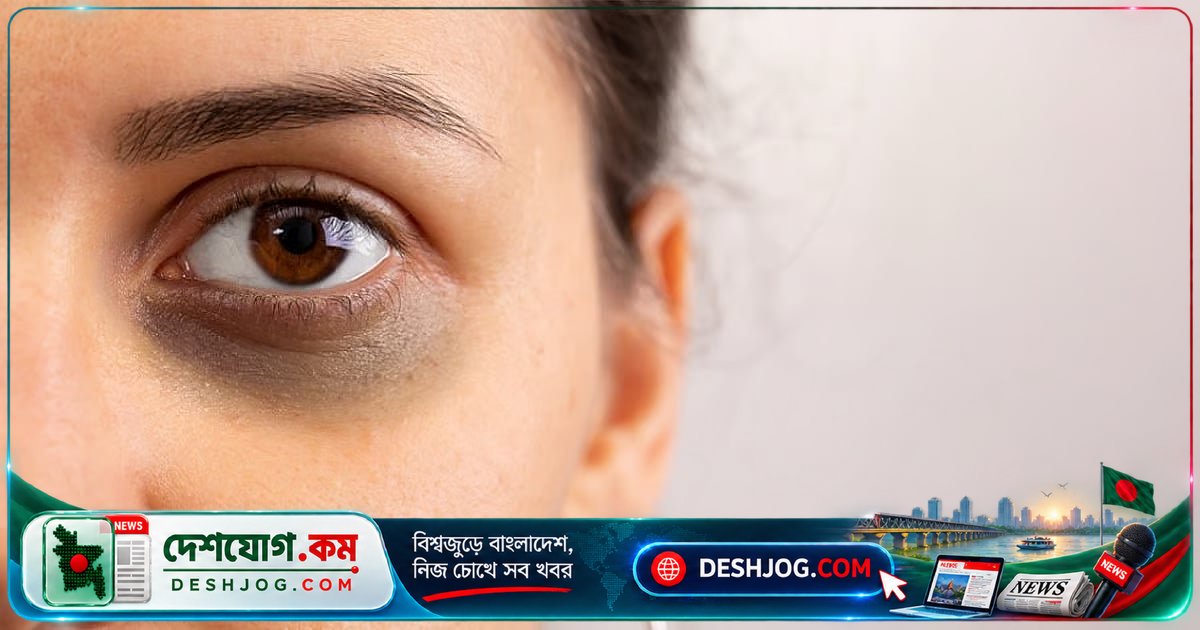 ঘুমের অভাব থেকে রক্ষা পাওয়ার উপায়: চোখের নিচের কালচে দাগ ও ফোলা ভাব কীভাবে দূর করা যায়?