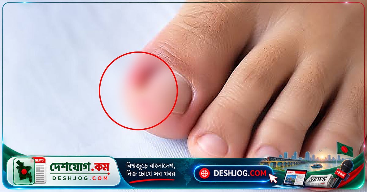 পায়ের নখের কোনা দেবে গেলে কী করবেন? ডাক্তারের পরামর্শ ও ঘরোয়া উপায়ের সত্য