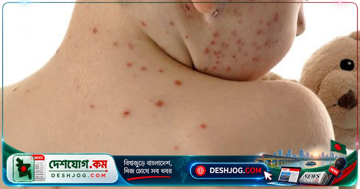 পেনসিলভানিয়ায় হামের ভয়াবহ প্রাদুর্ভাব: ৫ জনের মৃত্যু, ৯৪৩ জন সংক্রমিত, ১৭৬ জন হাসপাতালে ভর্তি