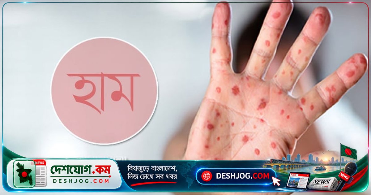 ১৭৯ দিনে হামে মারা যায় ১০০২ শিশু, গত ২৪ ঘণ্টায় ৩ জনের মৃত্যু সন্দেহজনক হামে