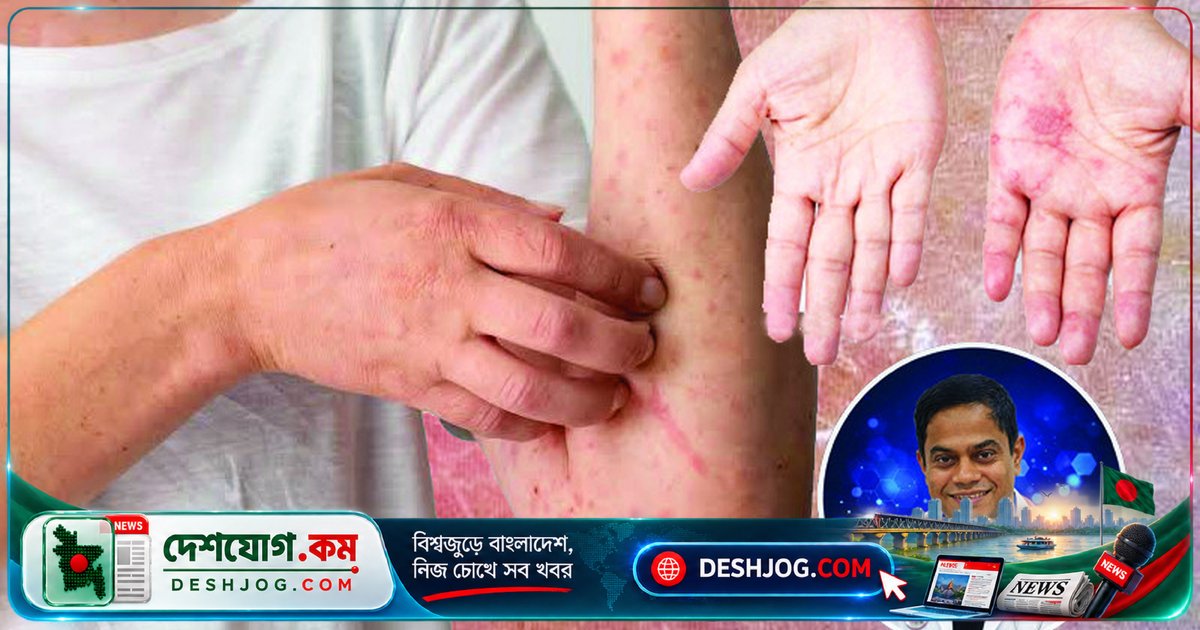 স্ক্যাবিস বা খোস-পাঁচড়া: বাংলাদেশে জাতীয় স্বাস্থ্য সমস্যা হয়ে দাঁড়িয়েছে, প্রতিরোধের পাঁচটি জরুরি পদক্ষেপ