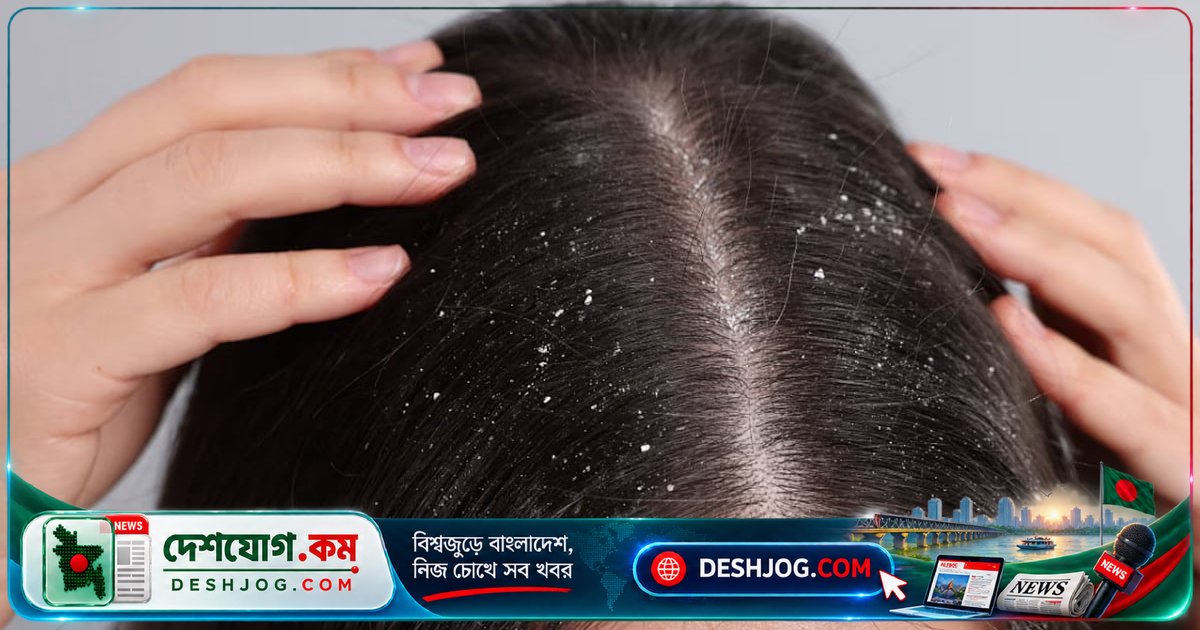 মাথার ত্বকে জমা হওয়া সাদা-ধূসর কণা স্ক্যাল্প বিল্ডআপ নাকি খুশকি?