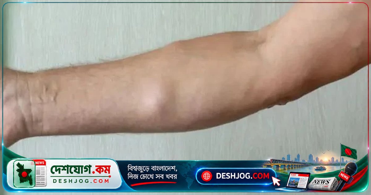 চামড়ার নিচে গোলাকার পিণ্ড: লাইপোমা কি ক্যানসারের পূর্বসূচক? চিকিৎসকদের সত্যি ব্যাখ্যা