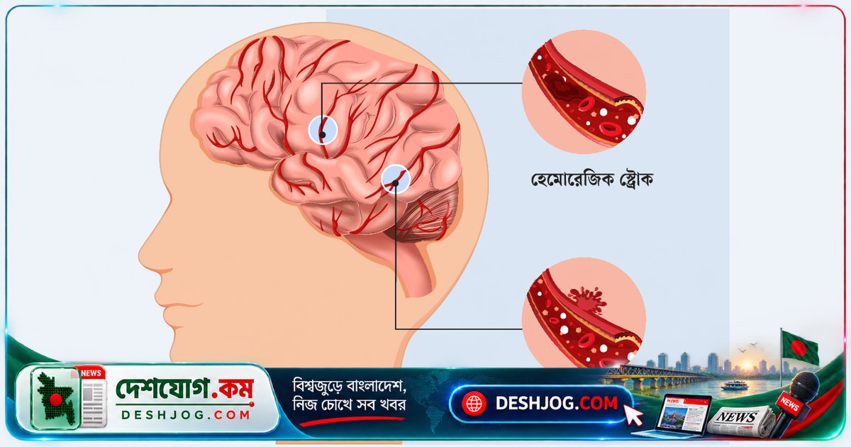 স্ট্রোকের জরুরি চিকিৎসা: সময়ের বিনিময়ে বাঁচতে পারে জীবন