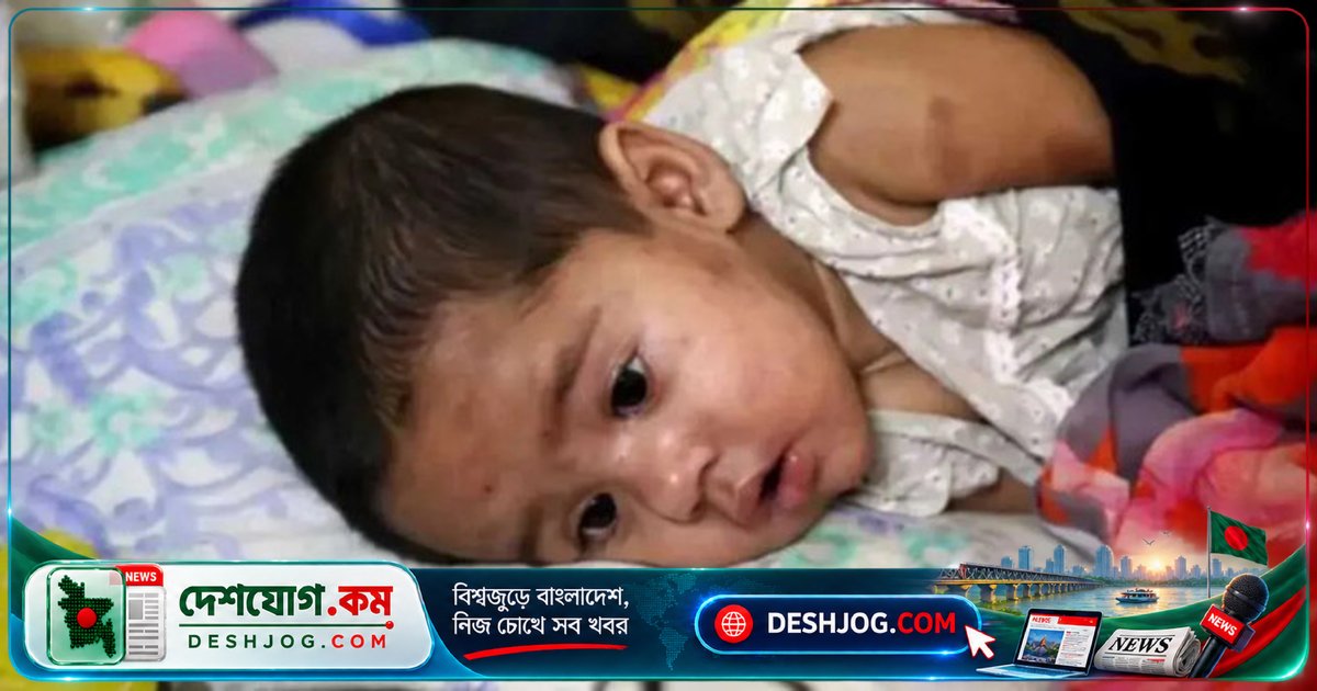 সিলেটে হামে ছয় মাস বয়সী শিশু মৃত্যুবরণ, ১৮১ জন নতুন ভর্তি হাসপাতালে
