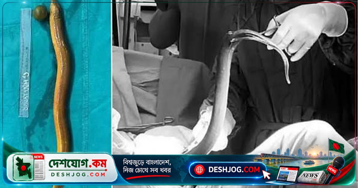 পেটে জ্যান্ত বাইম মাছ! সিলেটে অস্ত্রোপচার করে বের করা ৬৫ সেমি জীবন্ত মাছের বিরল ঘটনা বিজ্ঞান সাময়িকীতে প্রকাশিত