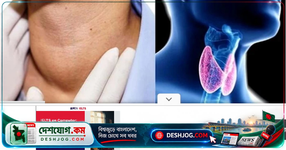 থাইরয়েড রোগে আক্রান্ত ৫ কোটি বাংলাদেশি: বিশেষজ্ঞদের সতর্কবার্তা ও সমাধানের পথ
