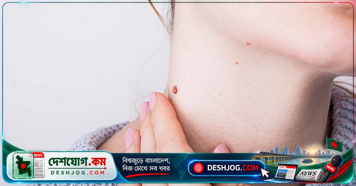 আঁচিলের কারণ, ছড়ানোর উপায় ও চিকিৎসার প্রয়োজনীয়তা: চিকিৎসকদের সতর্কবার্তা